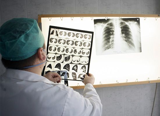 肺结核:肺结核患者的胸部x光检查